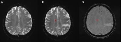 New Remote Cerebral Microbleeds on T2*-Weighted Echo Planar MRI After Intravenous Thrombolysis for Acute Ischemic Stroke